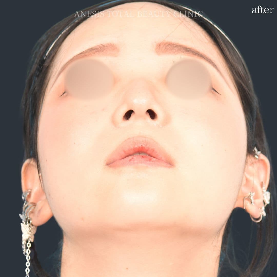 鼻翼縮小アフター