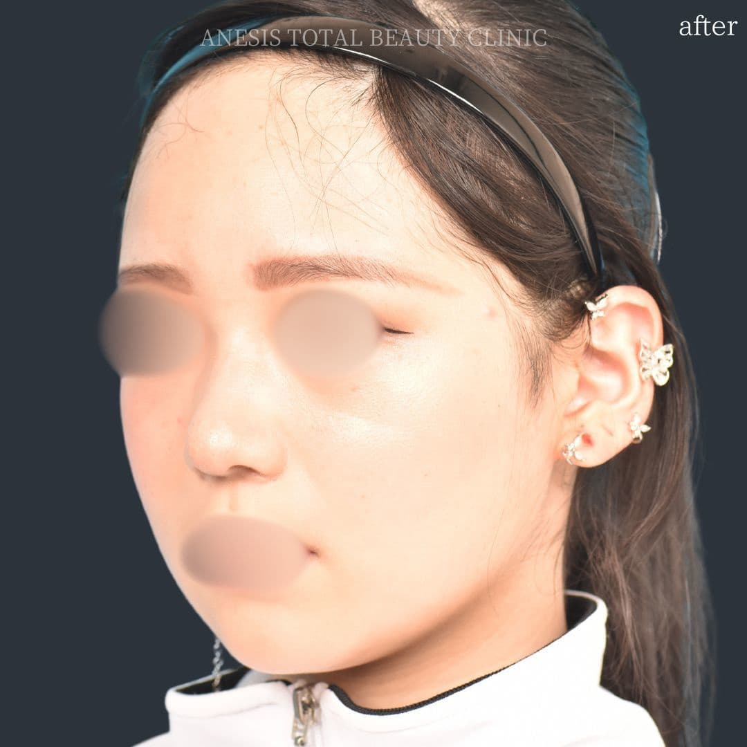 鼻翼縮小術アフター