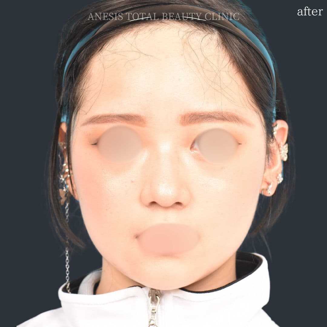 鼻翼縮小術アフター