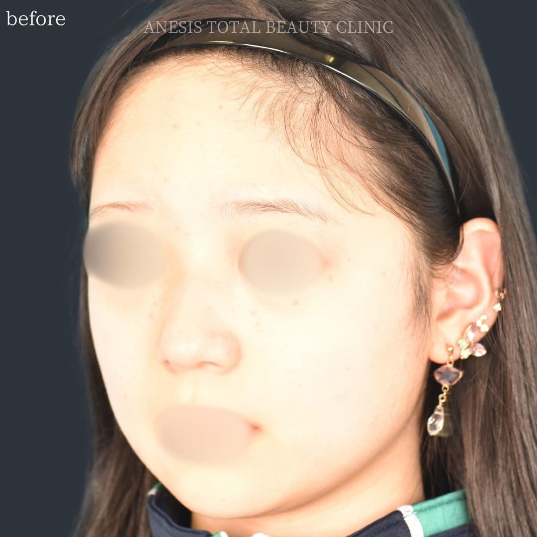 鼻翼縮小ビフォー