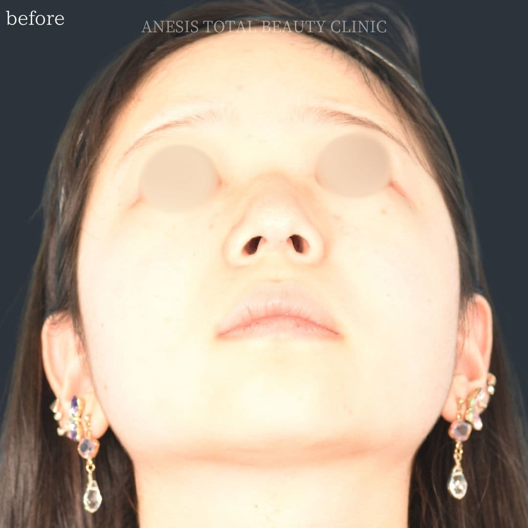 鼻翼縮小ビフォー