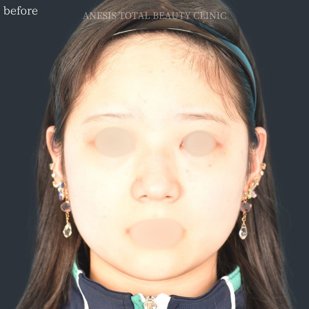 鼻翼縮小ビフォー