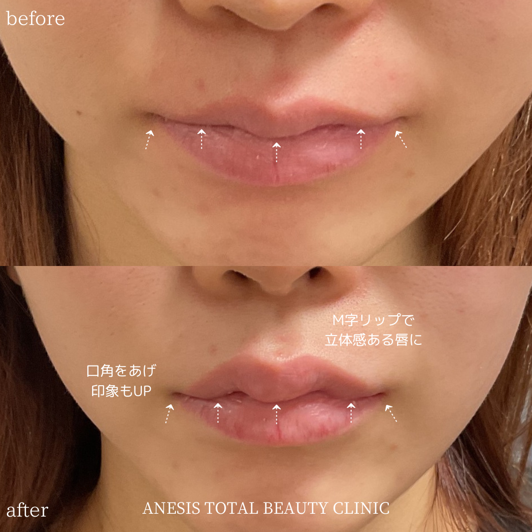 唇フィラービフォーアフター