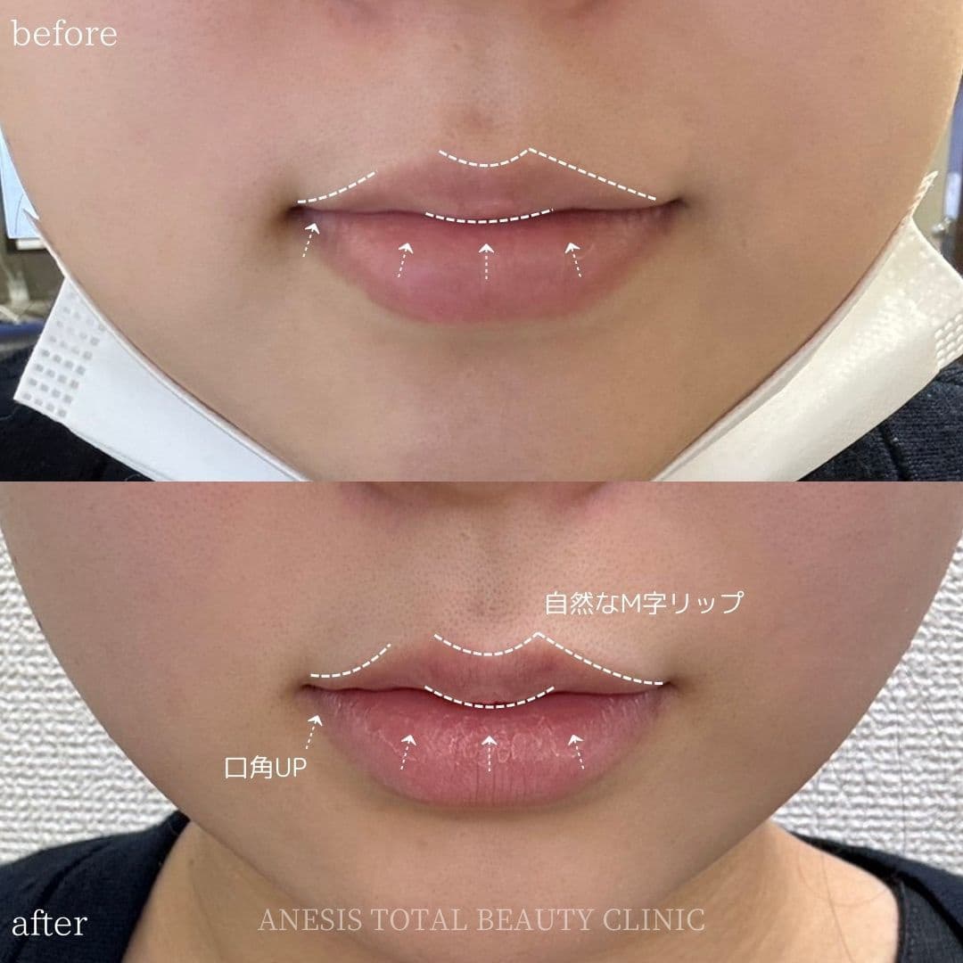 唇フィラービフォーアフター