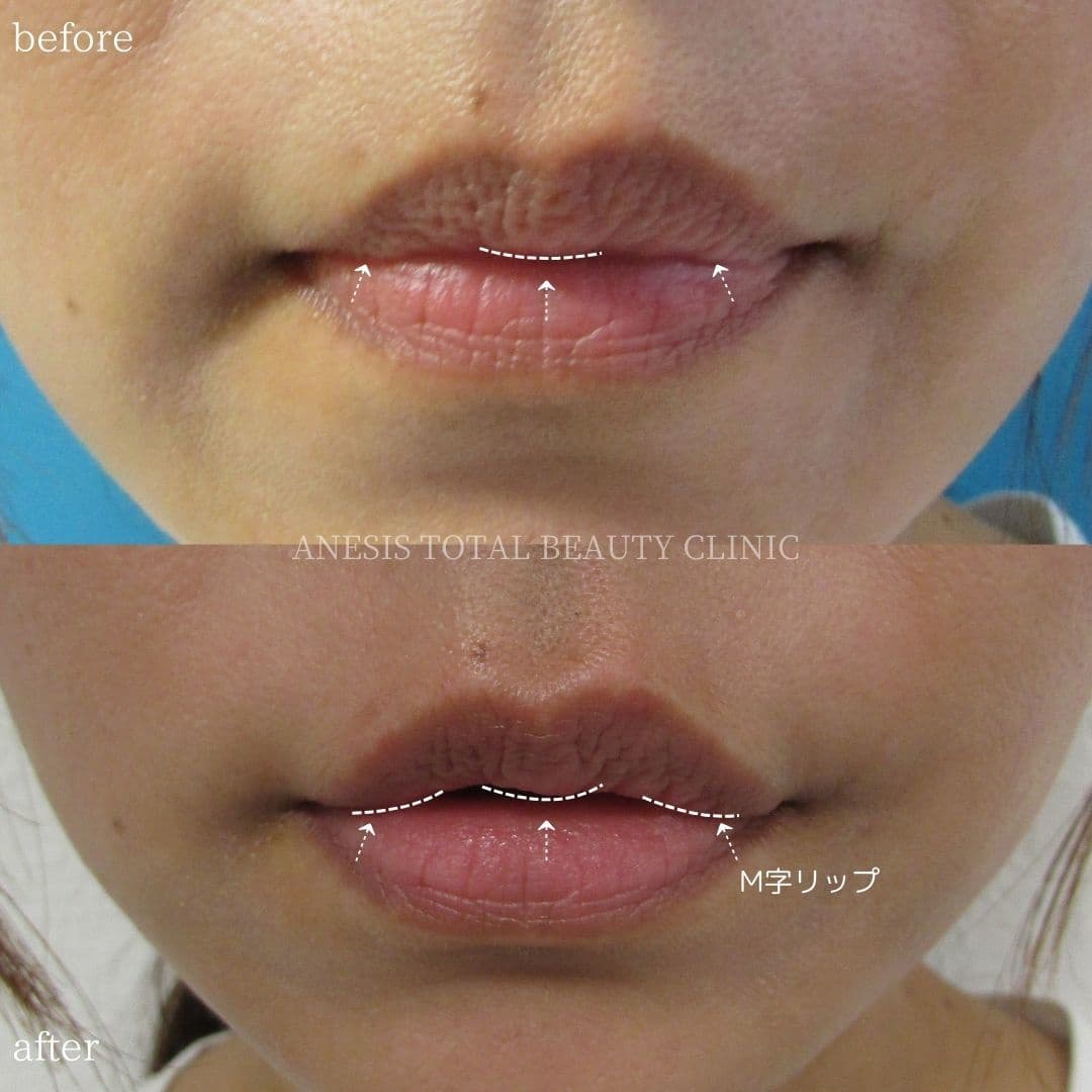 唇フィラービフォーアフター