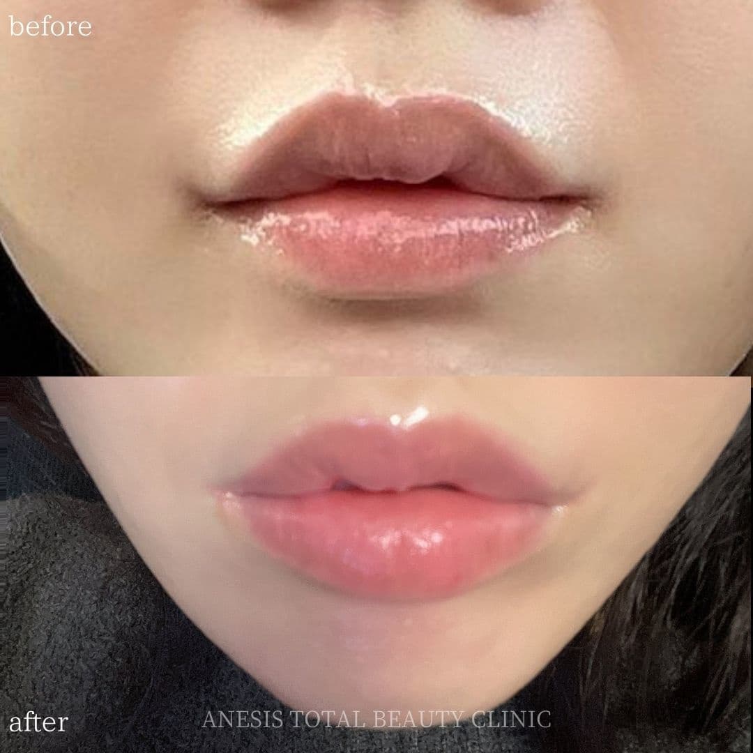 唇フィラービフォーアフター