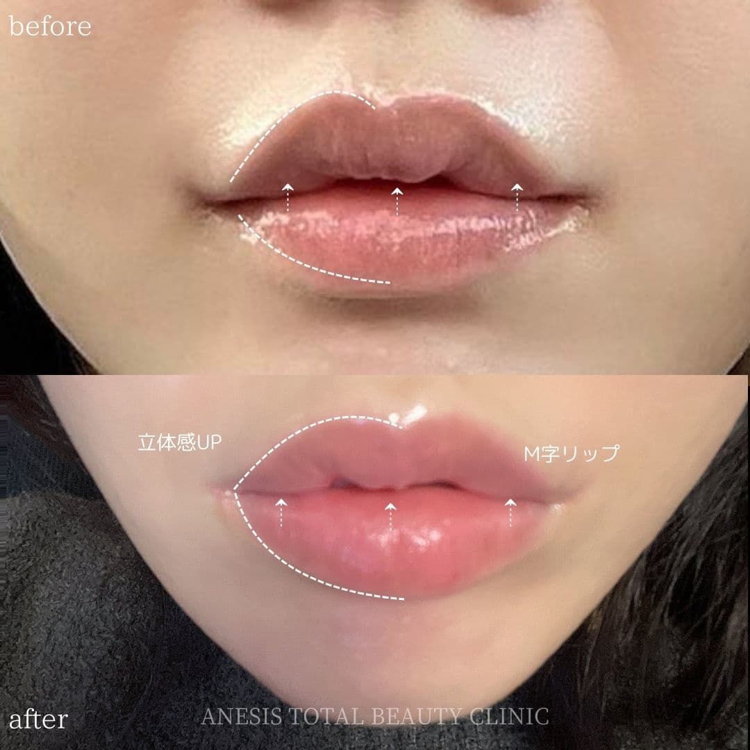 唇フィラービフォーアフター