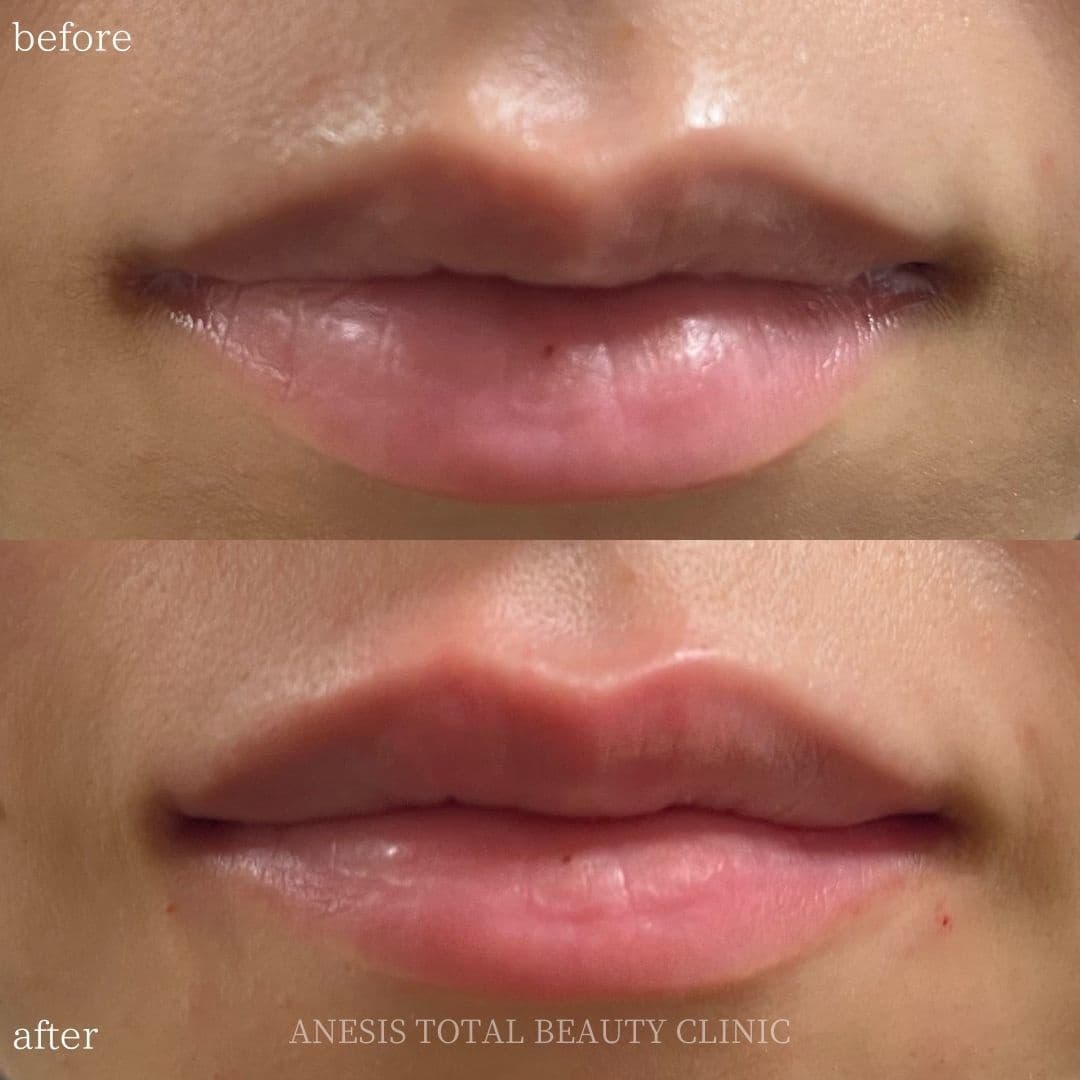 唇フィラービフォーアフター