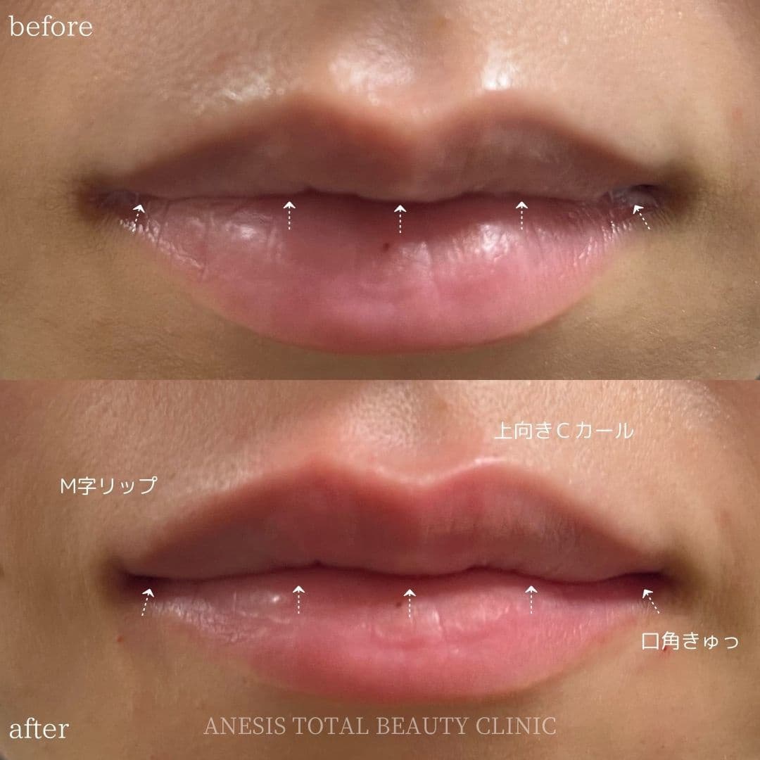 唇フィラービフォーアフター