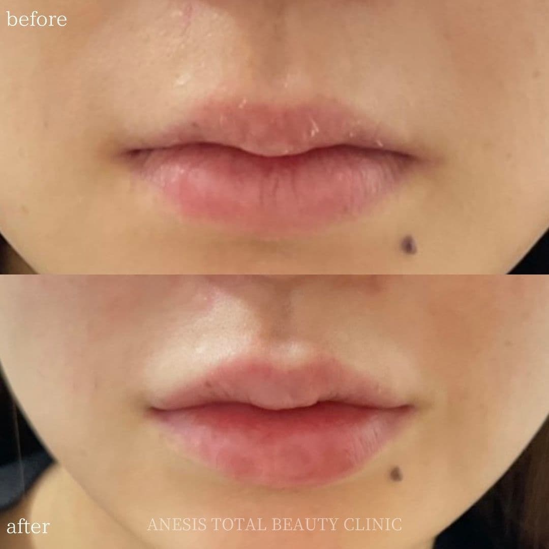 唇フィラービフォーアフター