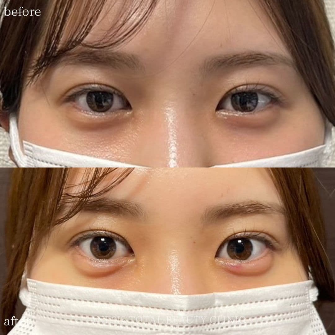 涙袋ヒアルロン酸ビフォーアフター