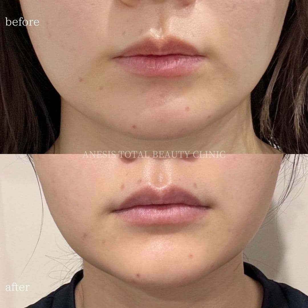 エラボトックスビフォーアフター