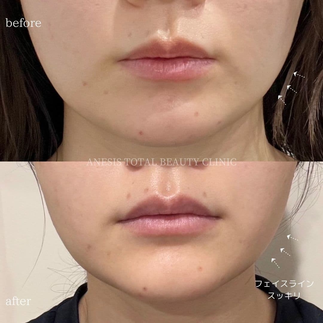 エラボトックスビフォーアフター