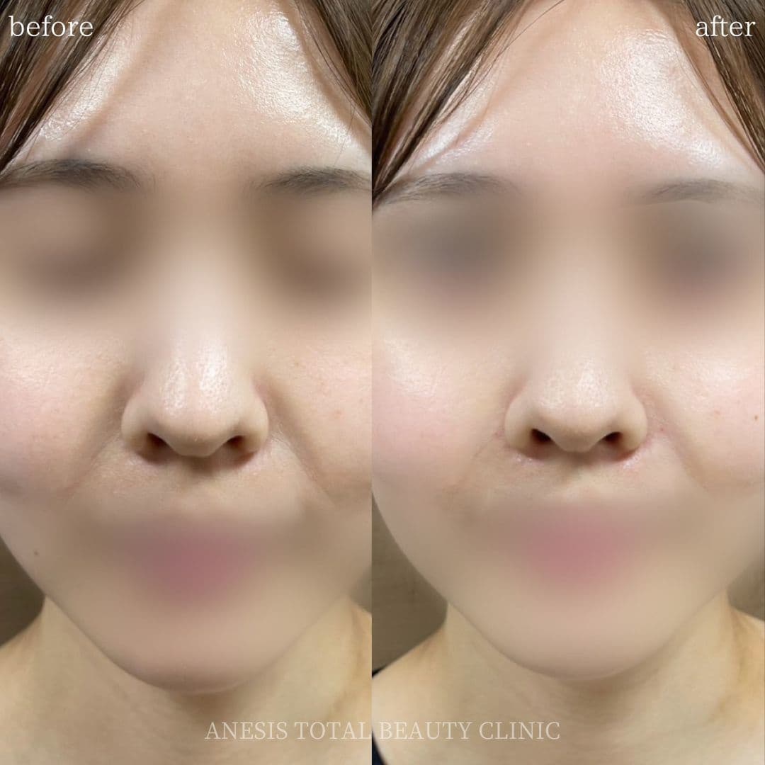 貴族フィラービフォーアフター