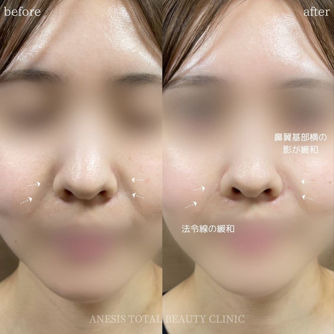 貴族フィラービフォーアフター