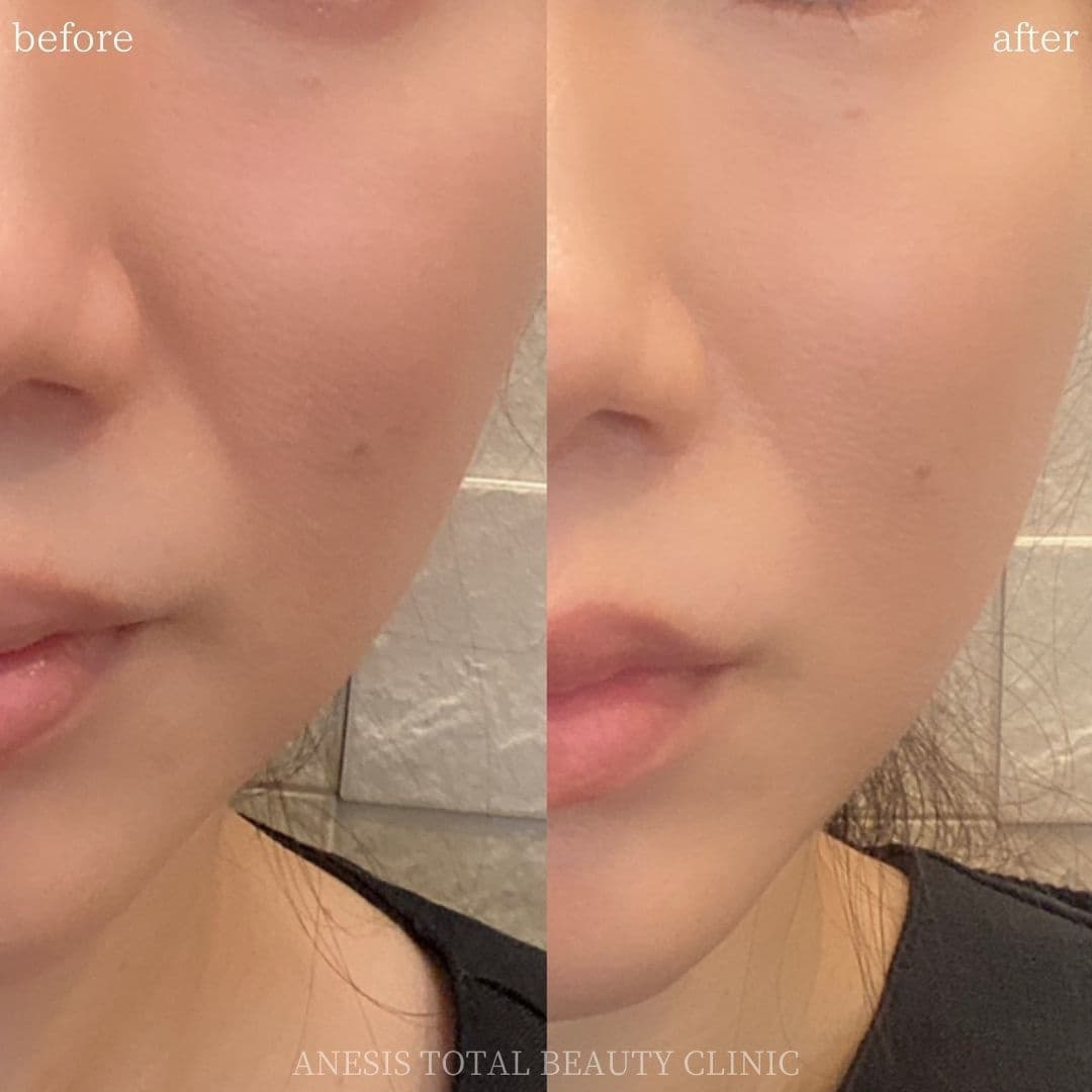 貴族フィラービフォーアフター