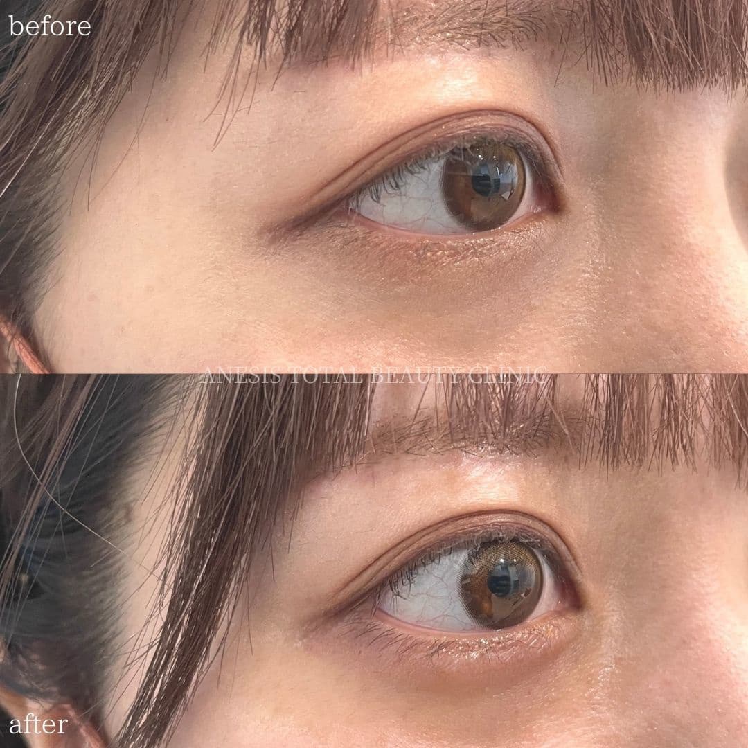 涙袋ヒアルロン酸ビフォーアフター