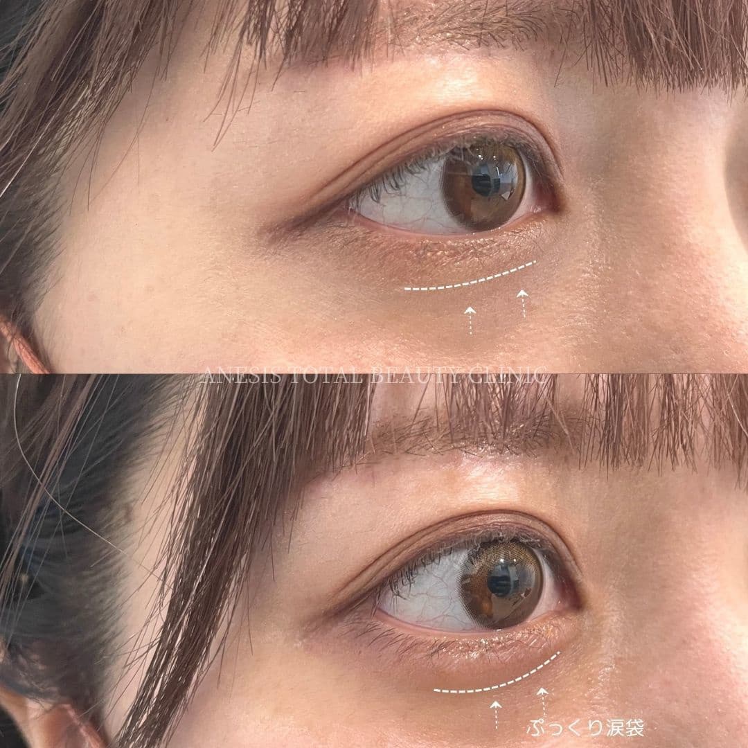 涙袋ヒアルロン酸ビフォーアフター
