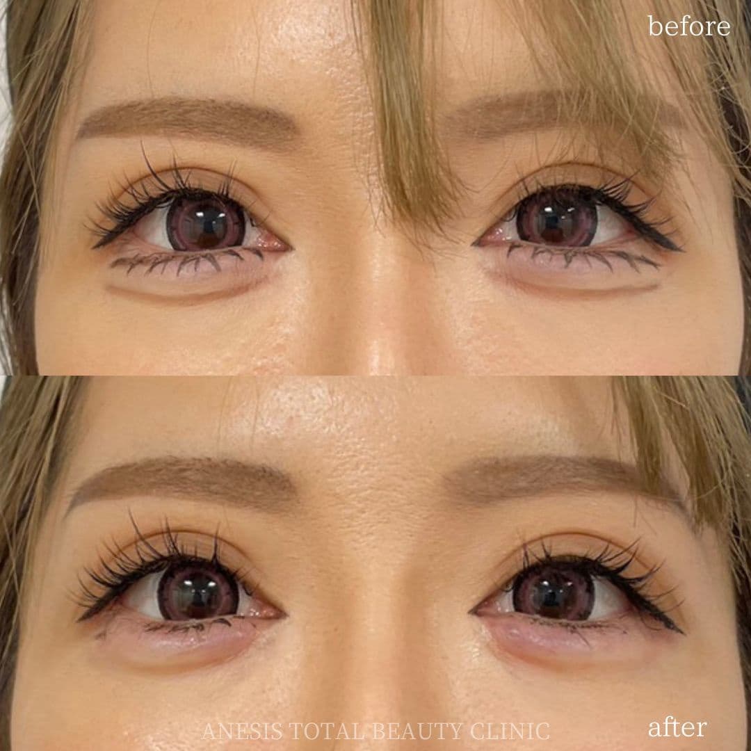 涙袋ヒアルロン酸ビフォーアフター