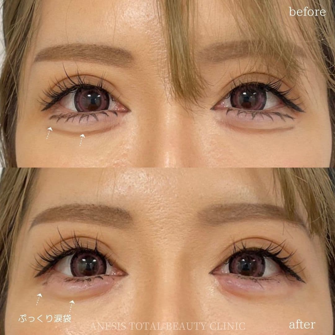 涙袋ヒアルロン酸ビフォーアフター