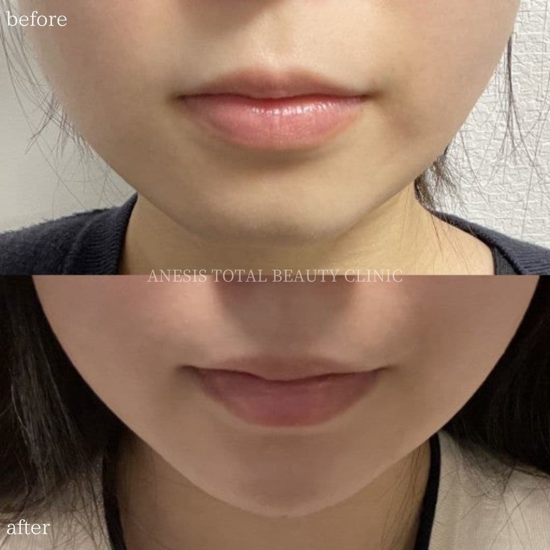あごヒアルロン酸ビフォーアフター