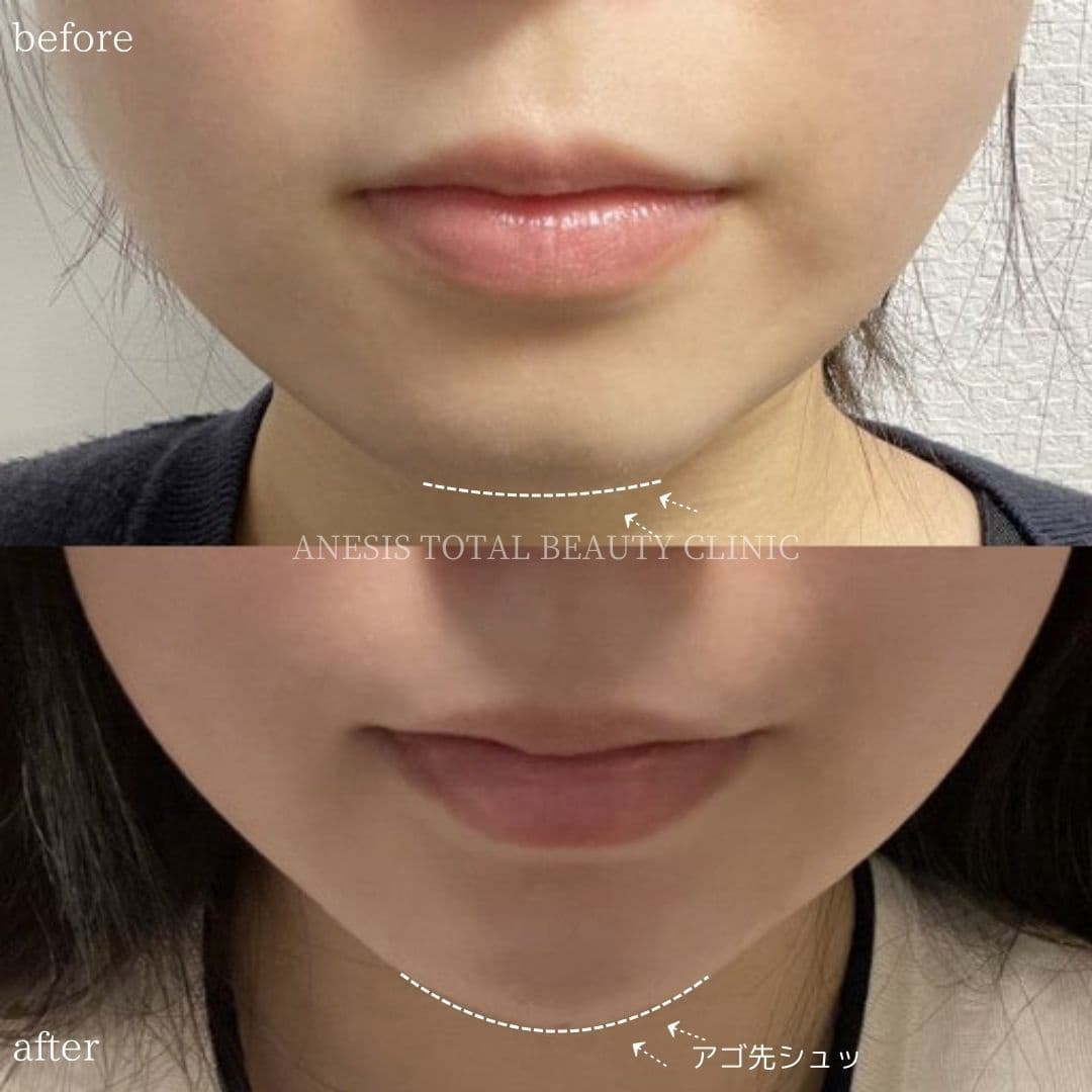 あごヒアルロン酸ビフォーアフター