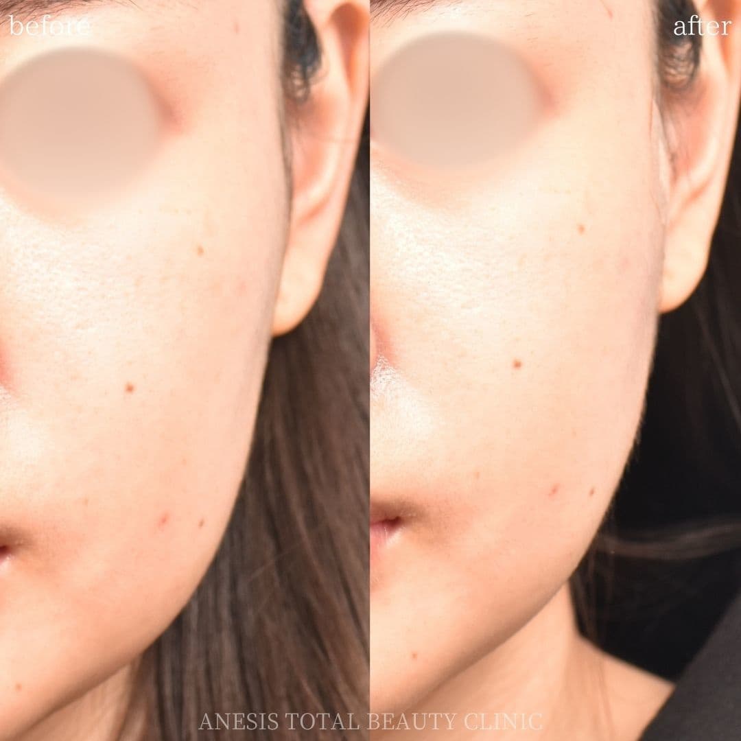 糸リフトビフォーアフター