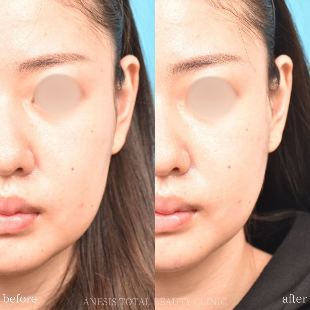 糸リフトビフォーアフター