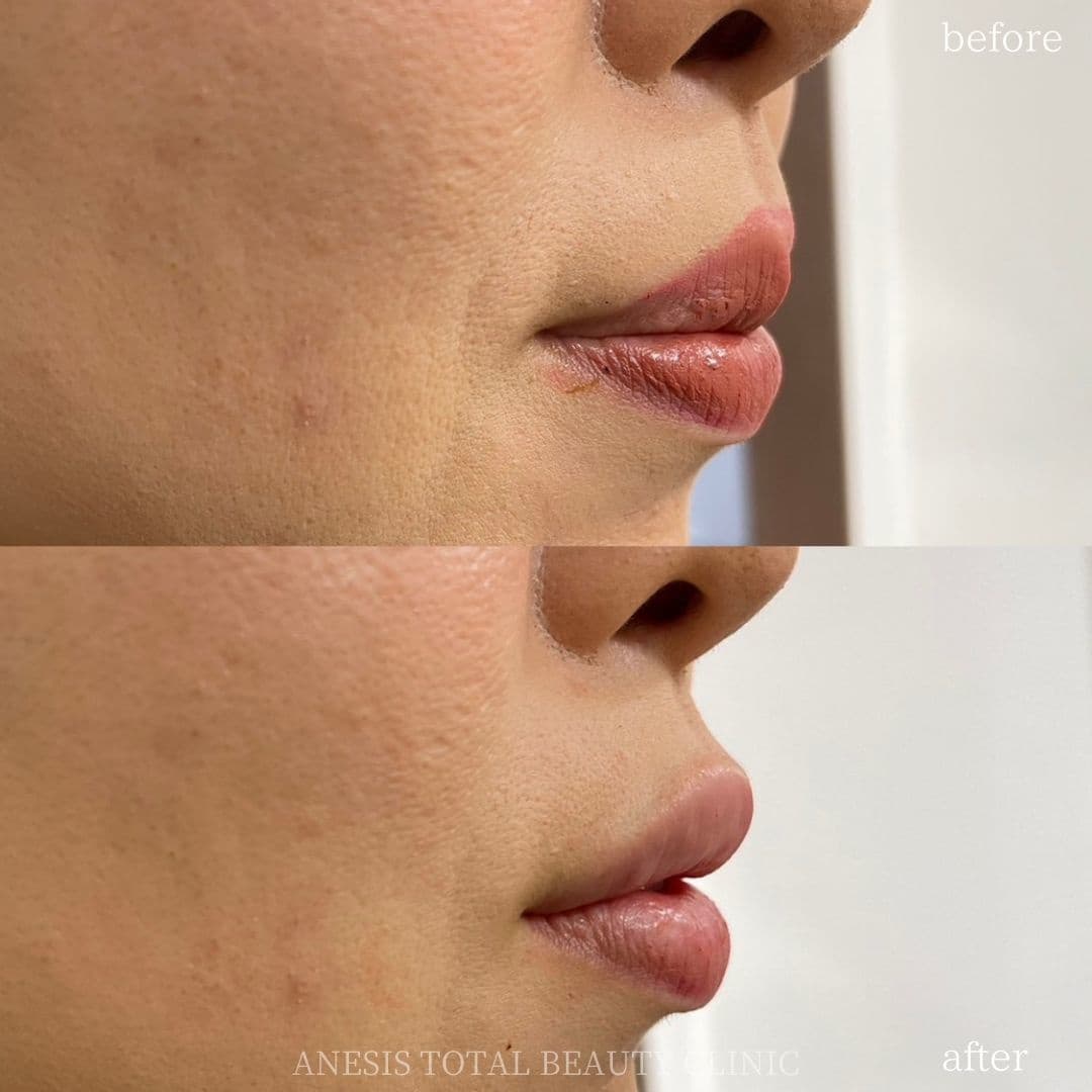 唇フィラービフォーアフター