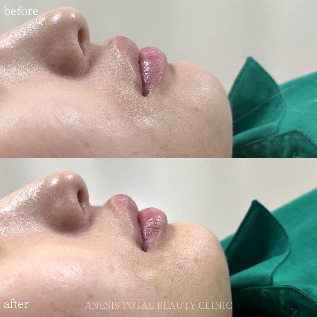 唇フィラービフォーアフター