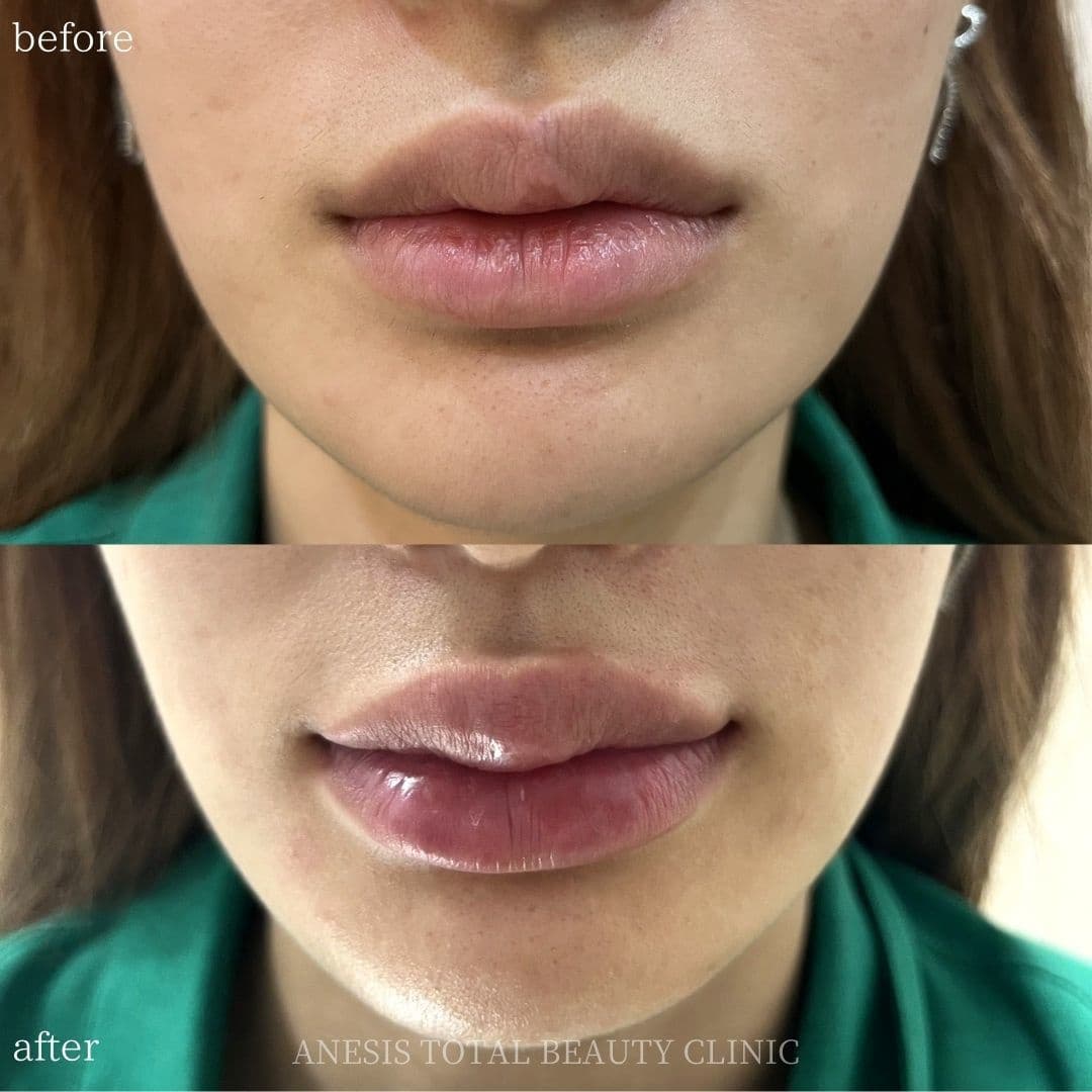 唇フィラービフォーアフター