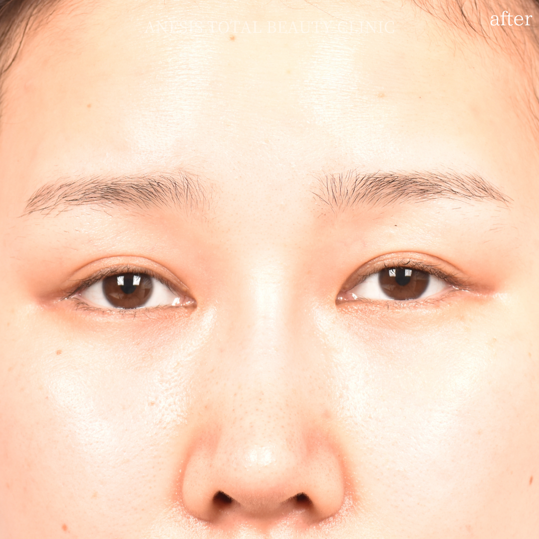 たれ目手術アフター