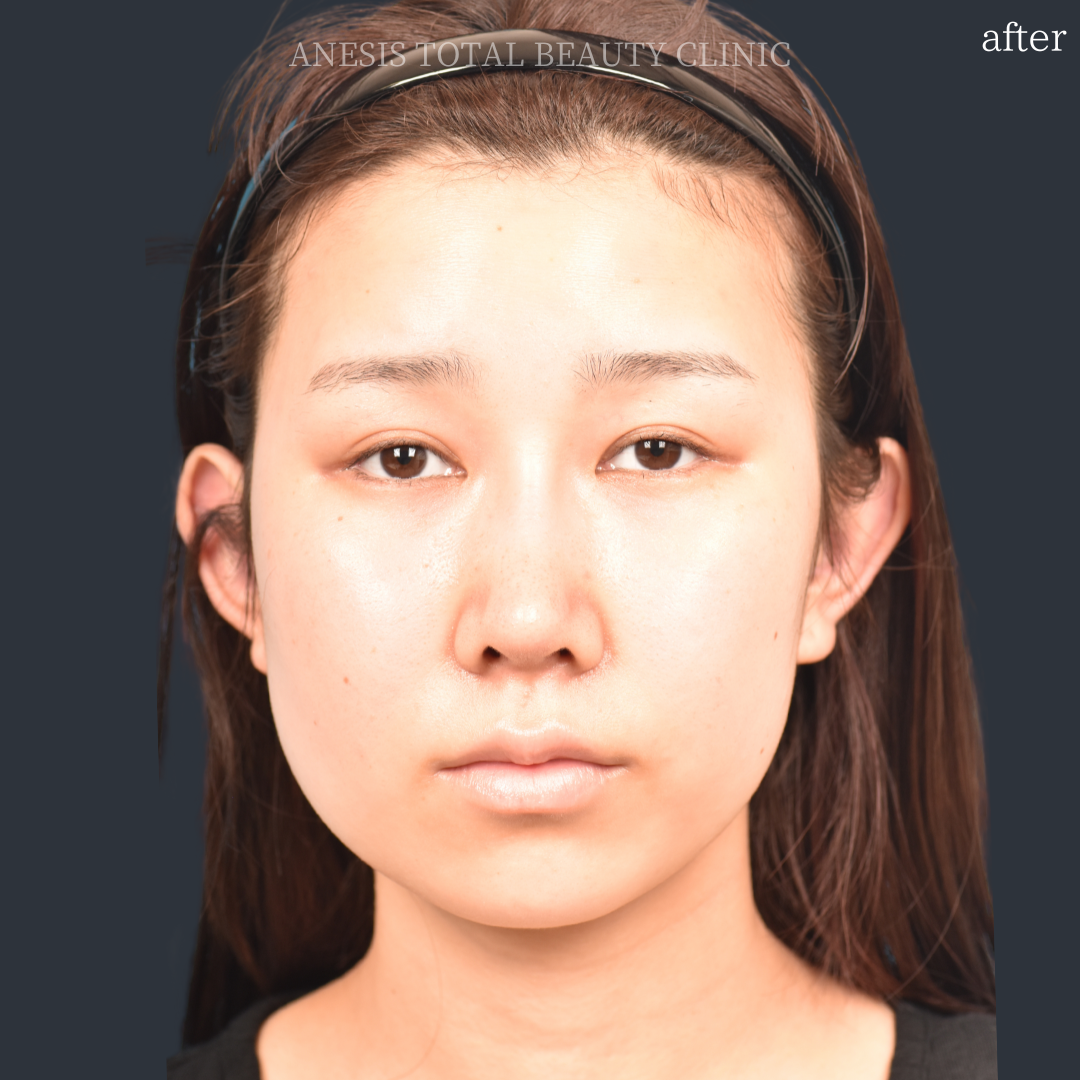 たれ目手術アフター