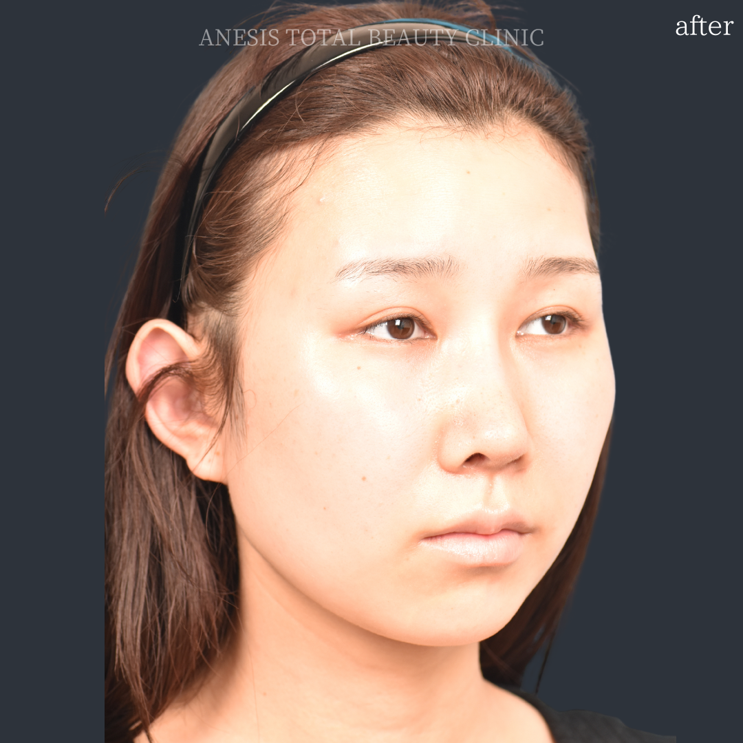 たれ目手術アフター