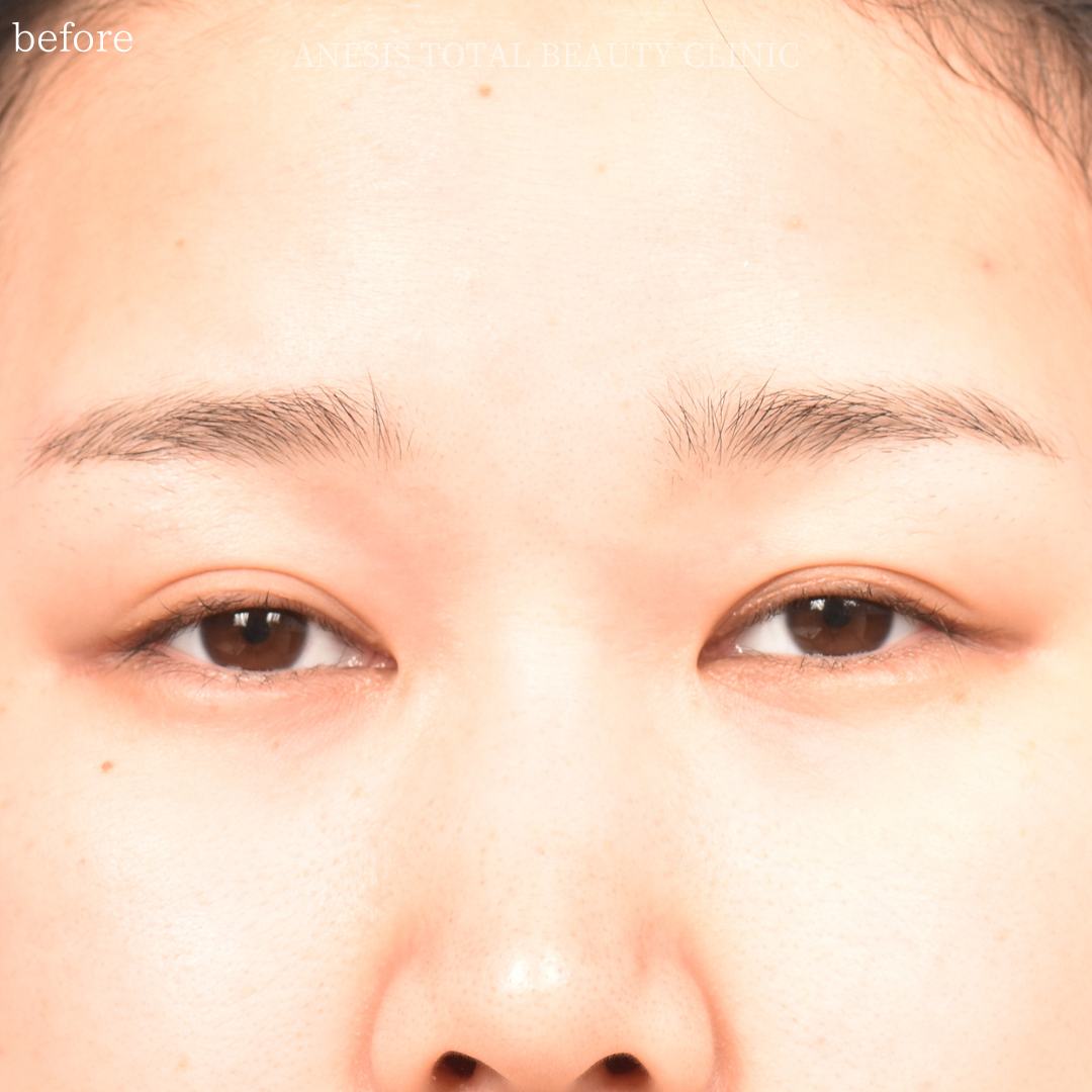 たれ目手術ビフォー