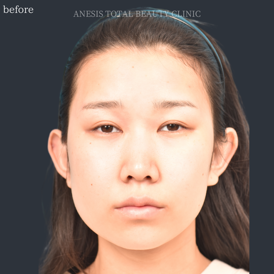 たれ目手術ビフォー