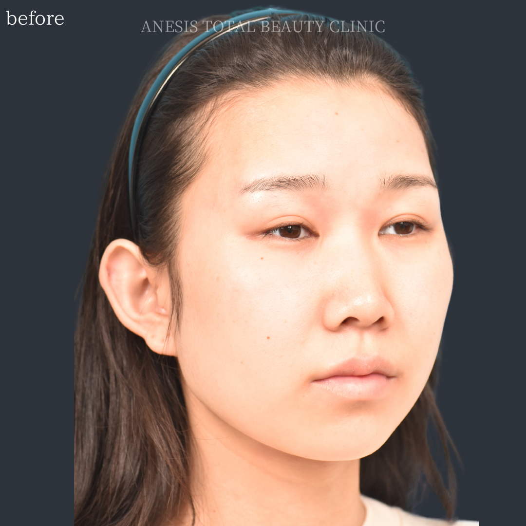 たれ目手術ビフォー