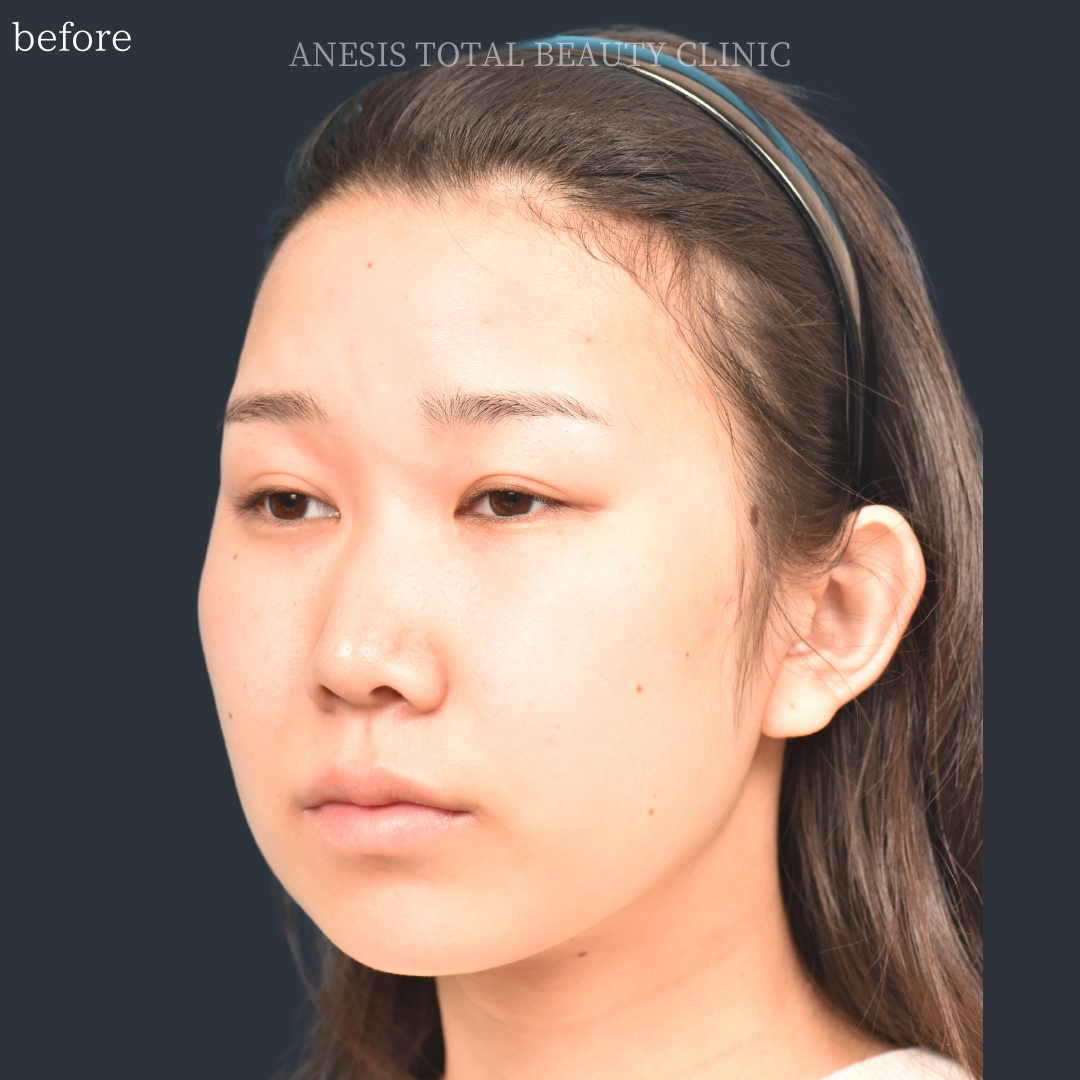 たれ目手術ビフォー