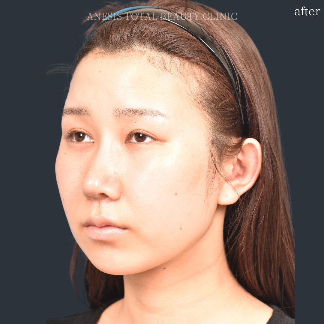 たれ目手術アフター