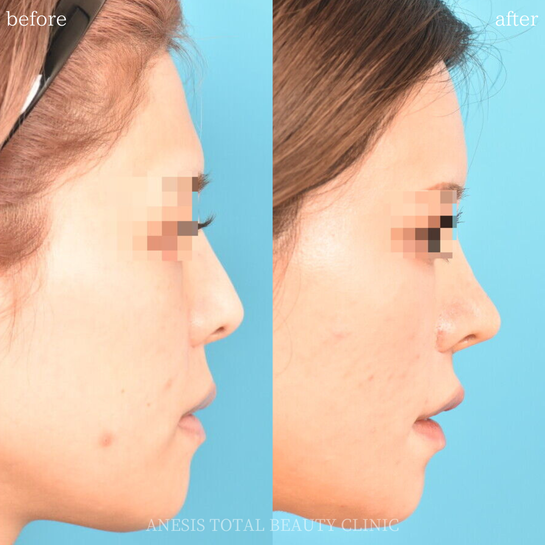 鼻整形ビフォーアフター