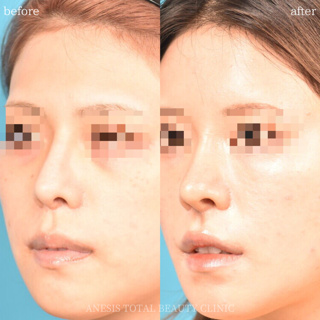 鼻整形ビフォーアフター