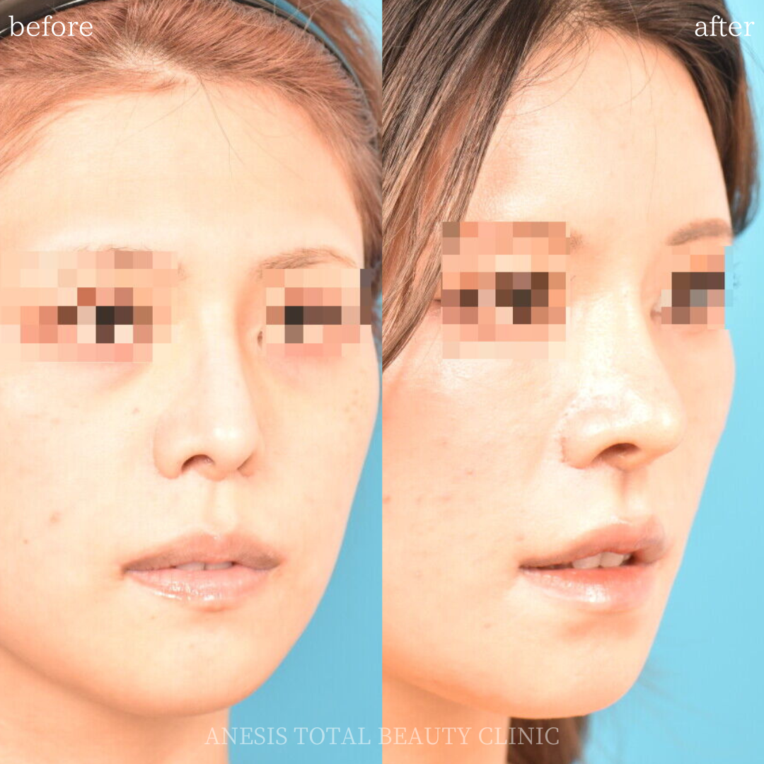 鼻整形ビフォーアフター