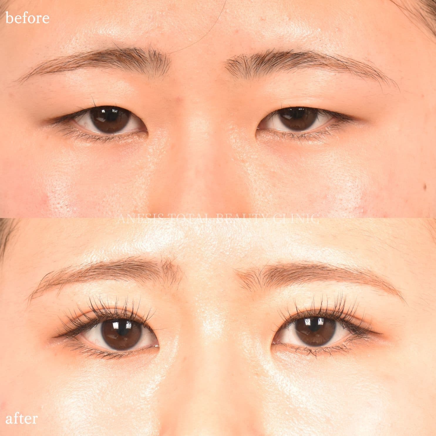 目整形ビフォーアフター