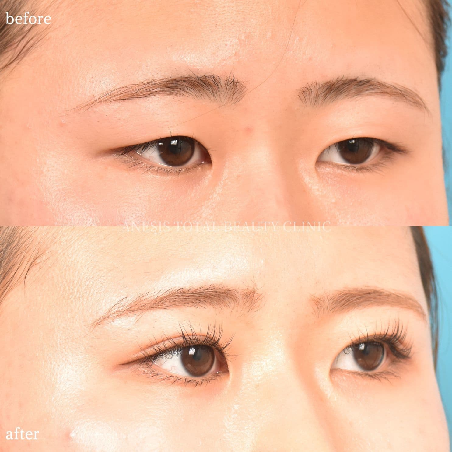 目整形ビフォーアフター