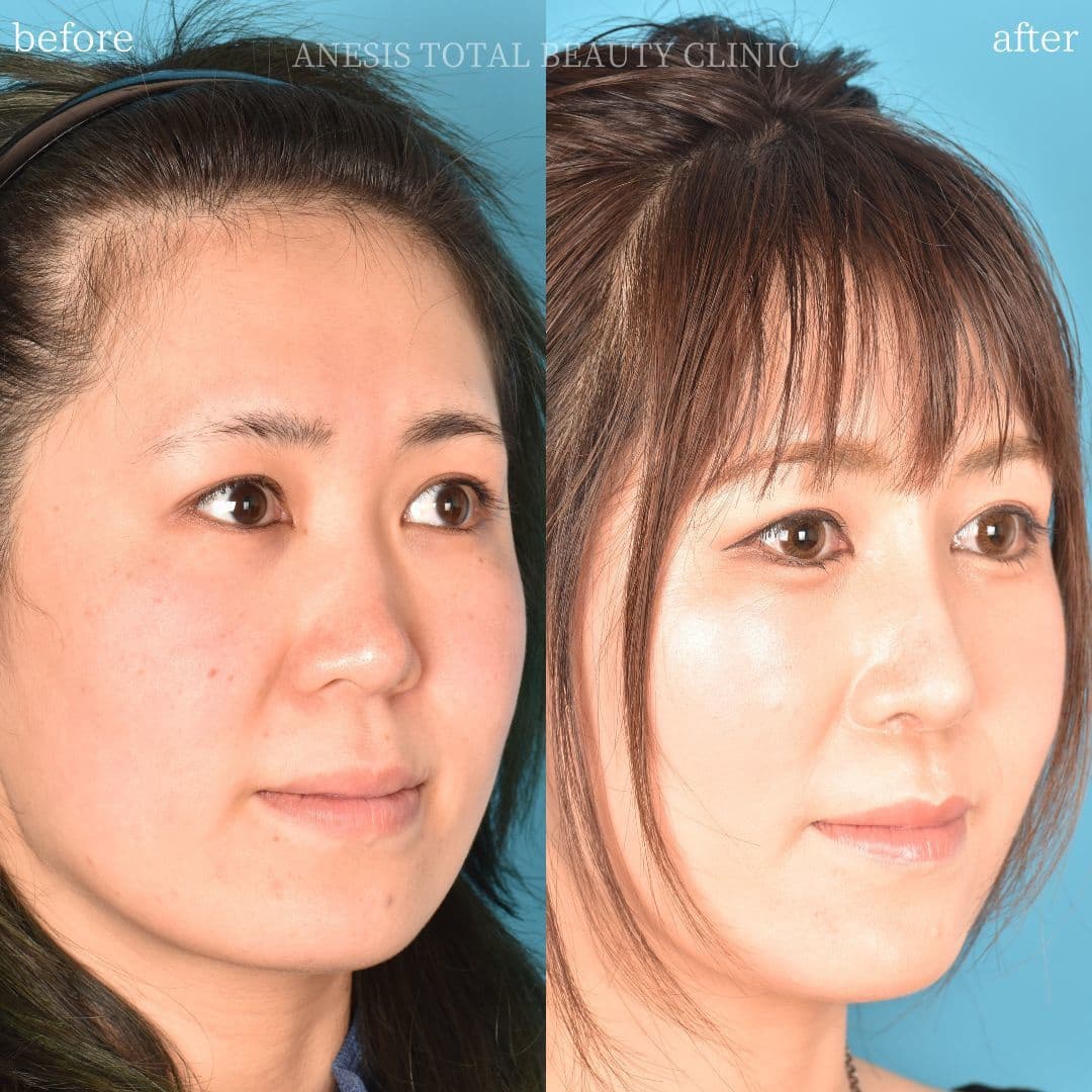 鼻整形ビフォーアフター