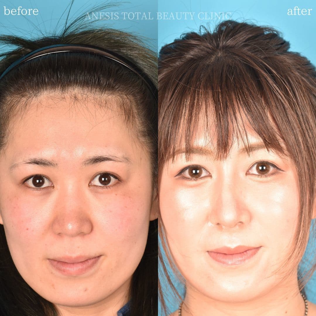 鼻整形ビフォーアフター