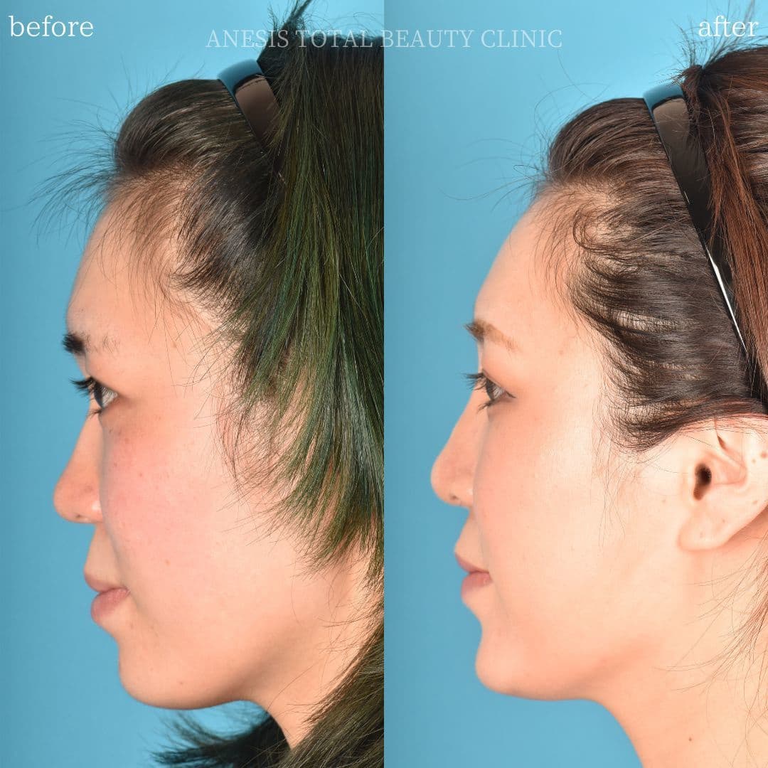 鼻整形ビフォーアフター