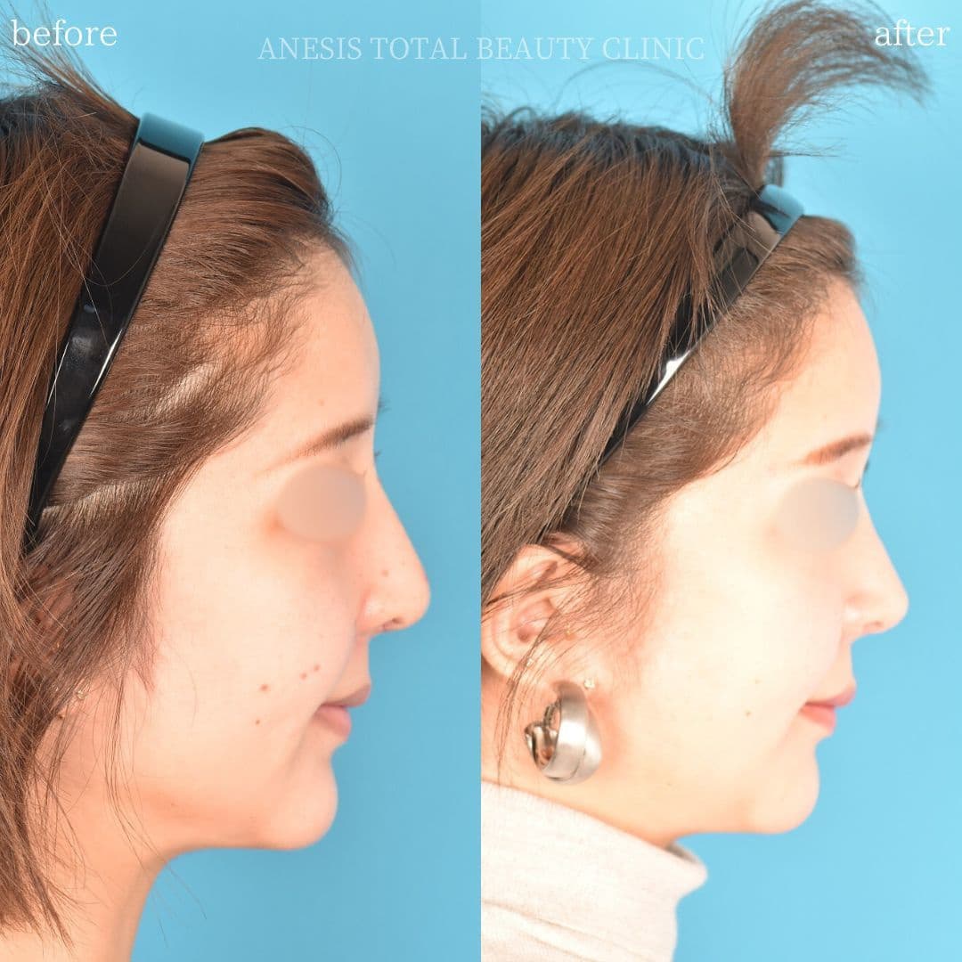 鼻整形ビフォーアフター