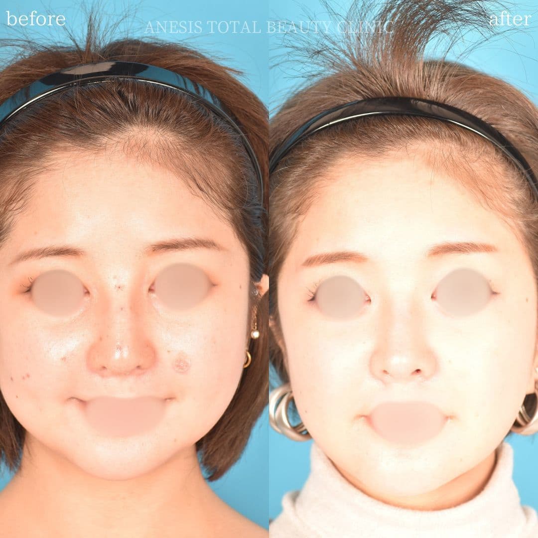 鼻整形ビフォーアフター