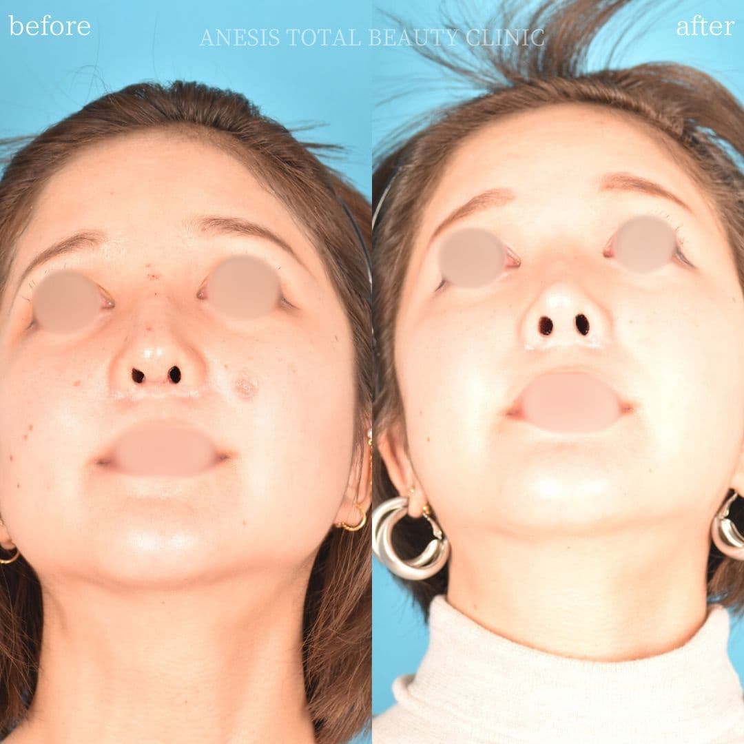 鼻整形ビフォーアフター